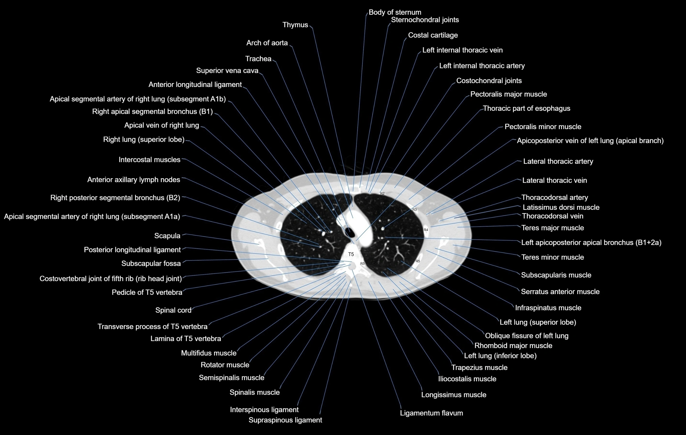 CT chest (thorax) labelled axial cross sectional anatomy radiology image-00035.webp